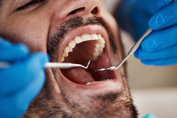 Best Emergency Tooth Extraction in Palm Shores, FL